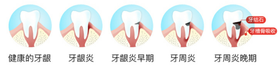 牙龈和牙周